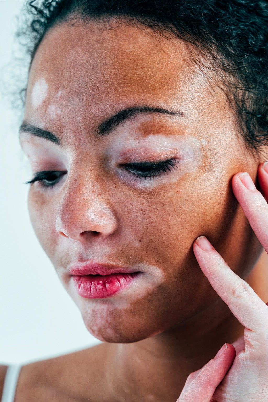 woman with vitiligo